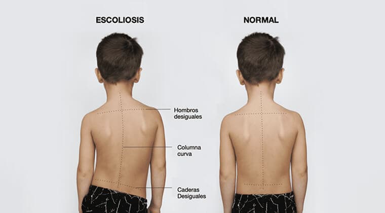 Imagen de Escoliosis