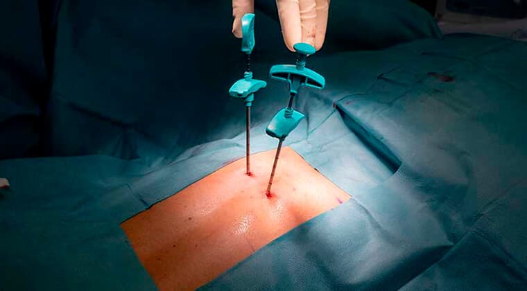 Consulta médica - cirugia-de-columna-minima-invasiva